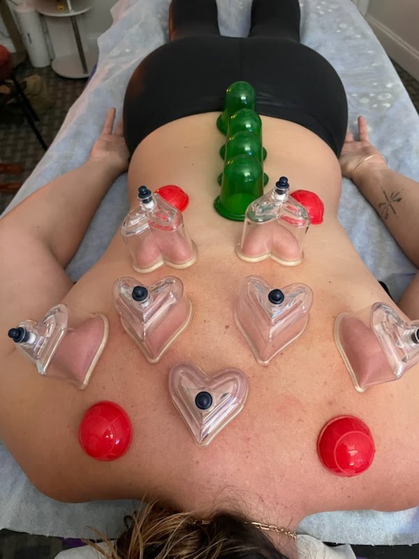 chinese cupping