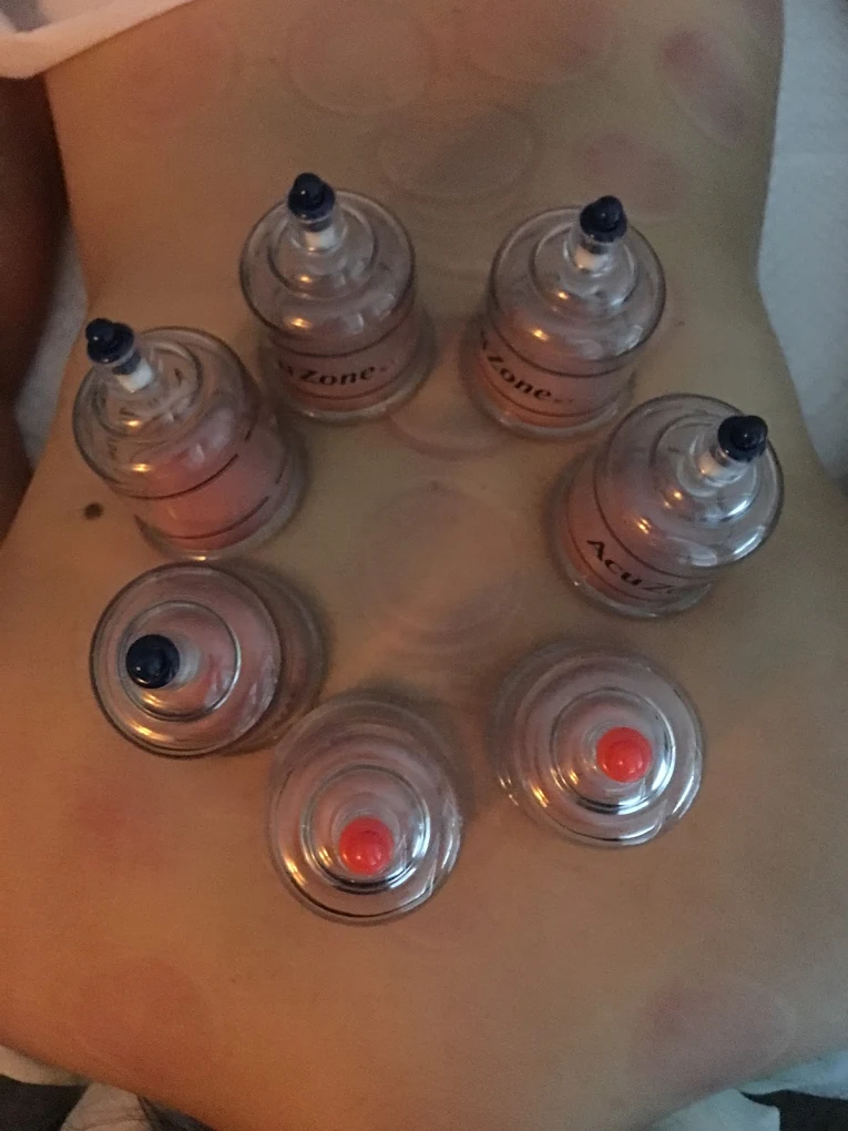 CHINESE CUPPING THERAPY