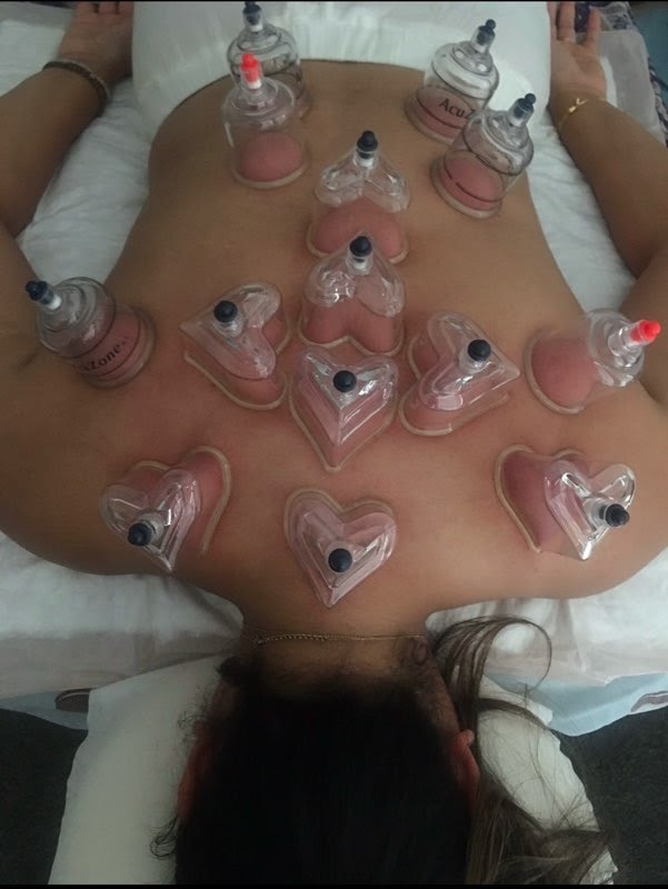 CHINESE CUPPING THERAPY