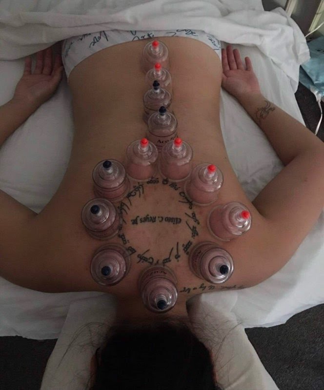CHINESE CUPPING THERAPY